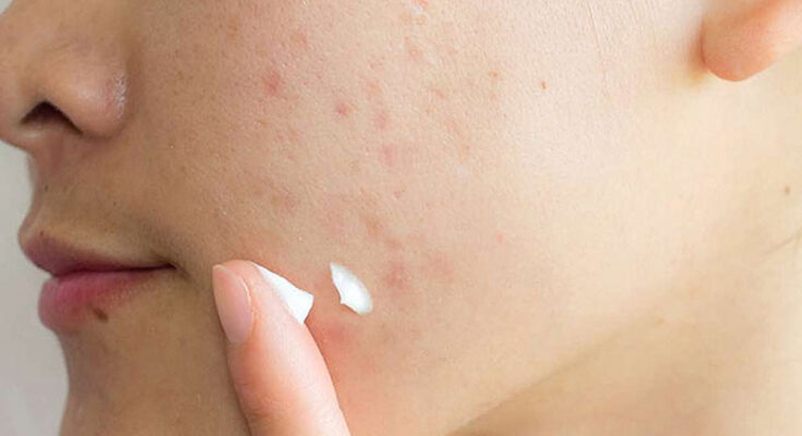 acne-scars